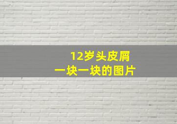 12岁头皮屑一块一块的图片