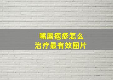 嘴唇疱疹怎么治疗最有效图片