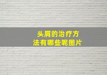 头屑的治疗方法有哪些呢图片