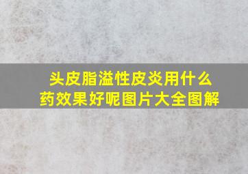 头皮脂溢性皮炎用什么药效果好呢图片大全图解