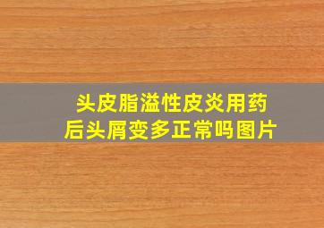 头皮脂溢性皮炎用药后头屑变多正常吗图片