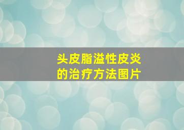 头皮脂溢性皮炎的治疗方法图片