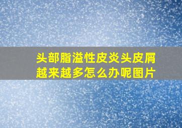 头部脂溢性皮炎头皮屑越来越多怎么办呢图片