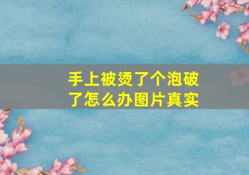 手上被烫了个泡破了怎么办图片真实