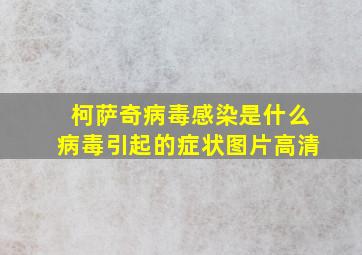 柯萨奇病毒感染是什么病毒引起的症状图片高清