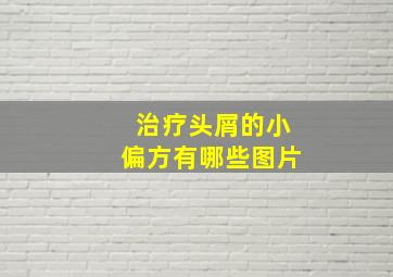 治疗头屑的小偏方有哪些图片