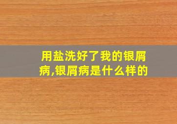 用盐洗好了我的银屑病,银屑病是什么样的